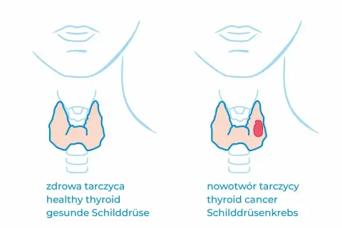 Vergleich von gesunder Schilddrüse und Schilddrüsenkrebs. Bei Krebs ist calcitonin erhöht, was auf eine Veränderung hinweist.