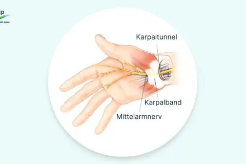 Anatomische Darstellung des Karpaltunnels, der den Mittelarmnerv und das Karpalband zeigt. Mögliche Ursachen für Karpaltunnelsyndrom Symptome.