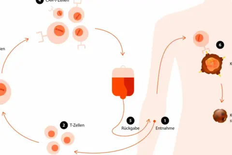Schema zeigt, wie schnell wirkt Immuntherapie: T-Zellen werden entnommen, modifiziert (CAR-T-Zellen) und zurückgegeben, um Krebszellen zu bekämpfen.
