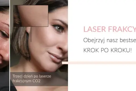 Laser frakcyjny: Jak szybko goić skórę? Poradnik krok po kroku