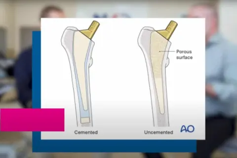 Porównanie endoprotez biodra: cementowana vs. befsmentowa. Długie czekanie na endoprotezę biodra to problem, ale technologia AO oferuje rozwiązania.