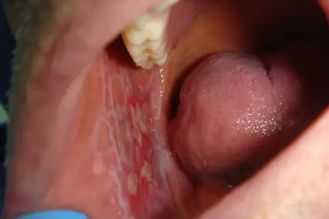 Lesioni biancastre e arrossate all'interno della bocca, possibili sintomi di lichen planus da stress.
