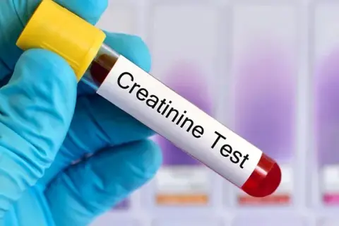 Kreatynina: przygotowanie do badania. Wyniki bez fałszu!