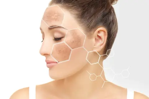 Mujer con manchas en la cara, destacadas con un patrón hexagonal.