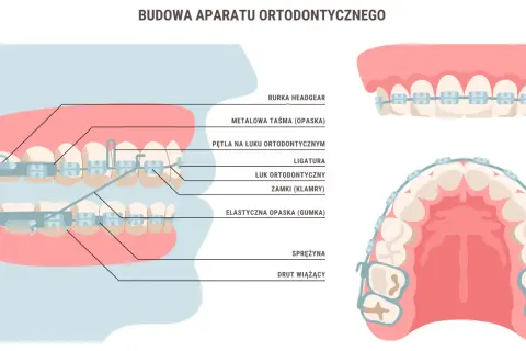Schemat aparatu ortodontycznego z widocznymi elementami, takimi jak zamki, łuk, ligatury i sprężynki.