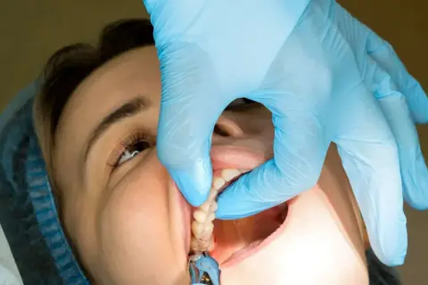 Dentysta w niebieskiej rękawiczce delikatnie wyciąga szwy z ust pacjentki. Czy ściąganie szwów boli?