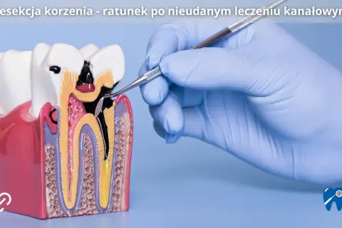 Model zęba z widocznym uszkodzeniem po nieudanym leczeniu kanałowym. Dłoń w rękawiczce stomatologicznej wykonuje resekcję korzenia.