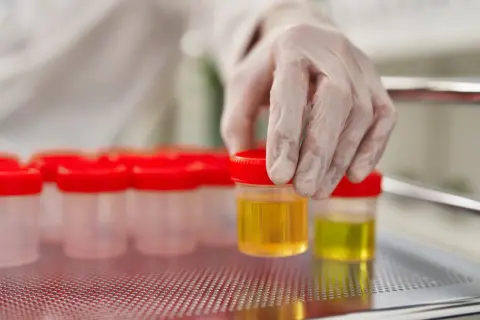 Ręka w rękawiczce laboratoryjnej wybiera pojemnik z żółtym płynem, prawdopodobnie badanie na obecność ketonów w moczu.