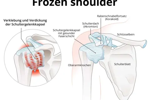 Schultergelenk mit verdickter Kapsel und entzündetem proc coracoideus. Veranschaulicht die Verklebung der Schultergelenkkapsel bei Frozen Shoulder.