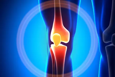Schmerzendes Knie mit entzündeten Knochen, ein Symbol für die "unhappy triad" des Knies.