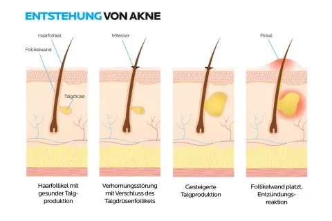 Illustrationen zeigen die Entstehung von Pickel Arten: gesunde Talgproduktion, Verhornungsstörung, gesteigerte Talgproduktion und Entzündungsreaktion.