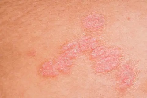 Nahaufnahme von **neurodermitis schuppiger haut**. Rote, erhabene Stellen mit silbrigen Schuppen auf der Haut.