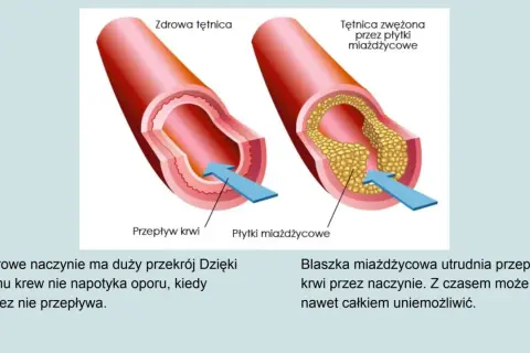 Porównanie zdrowej tętnicy z tą zwężoną przez płytki miażdżycowe. Układ krwionośny jest kluczowy dla zdrowia.