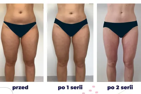 Przed i po kriolipolizie: widoczne efekty wyszczuplenia ud po 1 i 2 seriach zabiegu.
