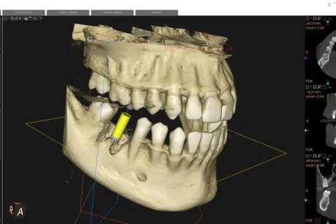 Visualizzazione 3D di un impianto dentale tramite cbct dentale. Sezioni assiali, coronali e sagittali mostrano dettagli ossei e dentali.