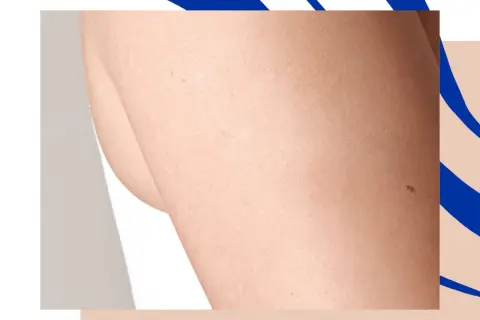Skóra z widocznymi porami i pieprzykami. Dermografizm przyczyny mogą być różne, od alergii po stres.