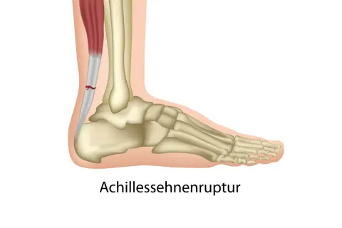 Achillessehnenruptur: Ein Riss in der Achillessehne, der durch Magnesiummangel begünstigt werden kann.