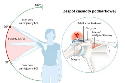 Ilustracja przedstawia zakres ruchu ramienia z zaznaczonym bólem oraz przekrój stawu barkowego z zaznaczonymi strukturami.