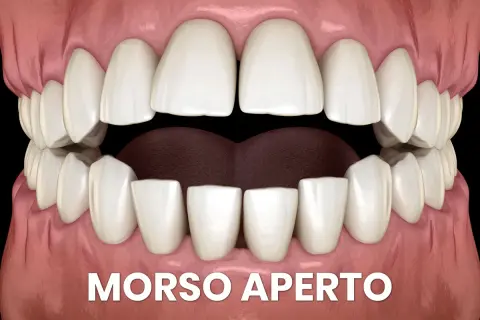 Denti bianchi e gengive rosa mostrano un morso aperto, con uno spazio evidente tra gli incisivi superiori e inferiori.