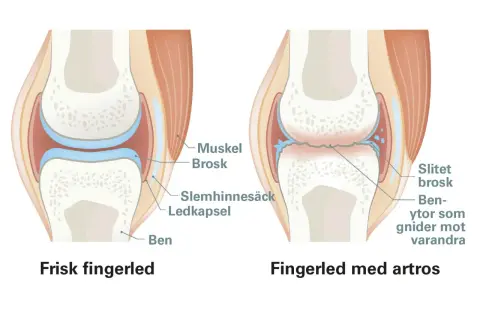 Jämförelse av frisk fingerled och fingerled med artros. Artros visar slitet brosk och benytor som gnider mot varandra, vilket kan förklaras med att osteofyter betyder benpålagringar.