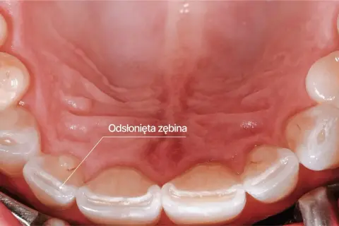 Widoczne odsłonięte zęby, objaw bruksizmu. Zęby są starte, co może prowadzić do bólu i nadwrażliwości.