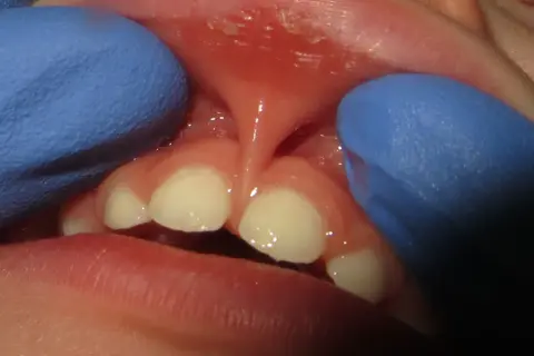 Close-up of a baby's mouth showing a lip tie. The frenulum is visible, and the baby's teeth are present. This condition can affect pacifier use.
