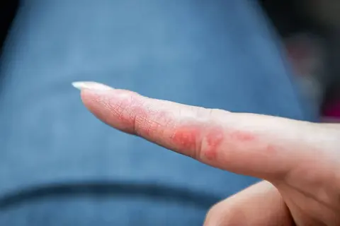 Alergia na nikiel w jedzeniu: objawy, diagnoza i dieta