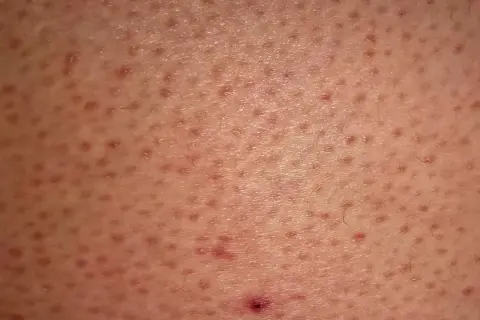 Skóra z licznymi drobnymi grudkami i zaczerwienieniami, charakterystycznymi dla rogowacenia mieszkowego (keratosis pilaris).