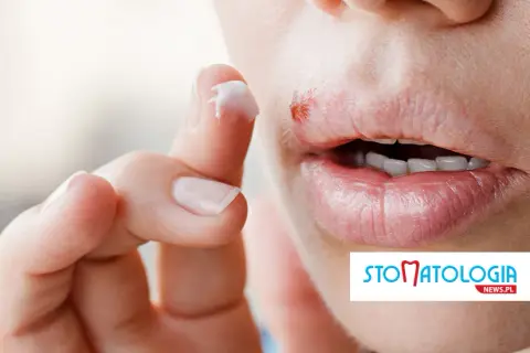 Masz opryszczkę przed dentystą? Sprawdź, kiedy możesz iść!