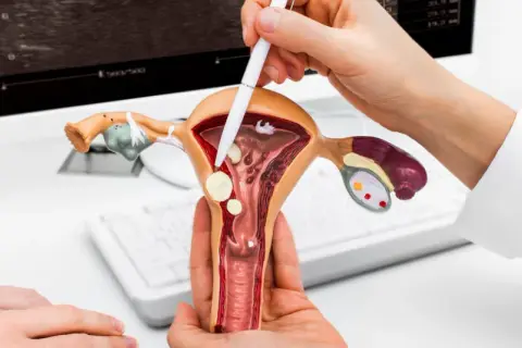 Model macicy z mięśniakami, wskazujący na pęknięcie mięśniaka macicy – objawy.
