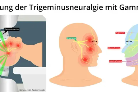 Darstellung der Gamma Knife Bestrahlung zur Behandlung von Trigeminusneuralgie. Grüne Strahlen zielen auf den Trigeminusnerv.