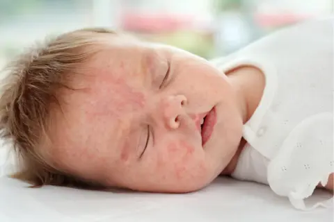 Alergia na mleko modyfikowane objawy – jak je rozpoznać i unikać?
