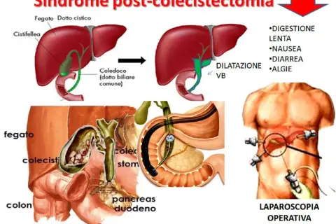 Illustrazione della sindrome post-colecistectomia, con diagrammi del fegato, cistifellea e vie biliari, e immagini di chirurgia laparoscopica. Vivere senza cistifellea può comportare disturbi digestivi.
