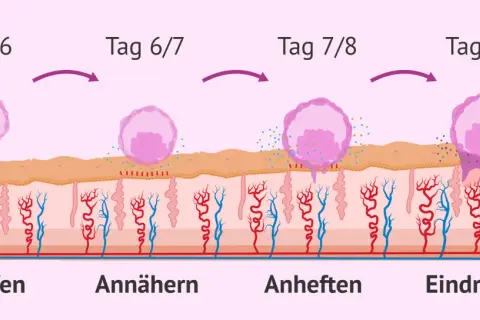 Was passiert nach dem Eisprung: Ein Embryo schlüpft, nähert sich, heftet sich an und dringt in die Gebärmutterschleimhaut ein.
