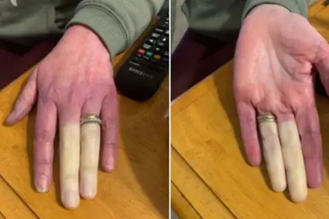 Zimne palce? Objawy Raynauda, czerwone flagi i diagnoza