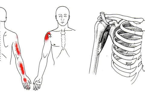 Schmerzpunkte am Arm und Schulterbereich, die auf den m coracobrachialis hinweisen. Detailansicht des Schultergelenks mit Muskeln und Rippen.