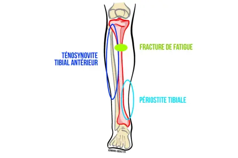 Schéma du tibia montrant les causes de douleur : fracture de fatigue, périostite tibiale et ténosynovite du tibial antérieur.