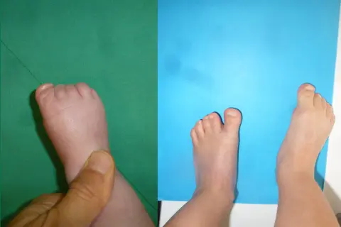 Pied d'enfant présentant une syndactylie de l'orteil, où les orteils sont fusionnés.