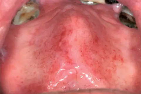 Mucose della bocca con petecchie rosse e aree infiammate, evidenziando una possibile reazione.