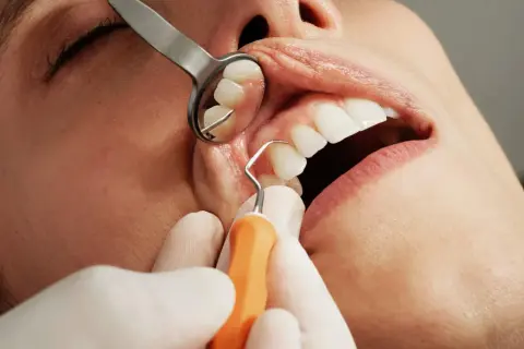 Zabieg stomatologiczny: czy po usuwaniu kamienia można jeść? Dentysta bada zęby pacjenta lusterkiem i narzędziem.