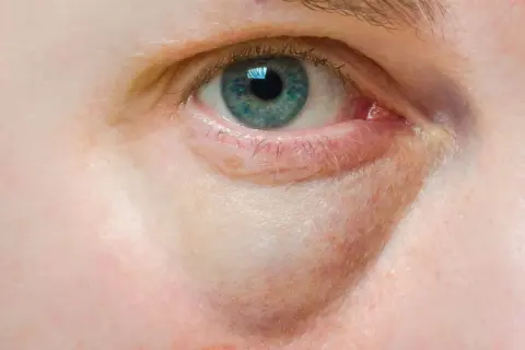 Oko z widocznymi kępkami żółtymi pod powieką, które mogą świadczyć o problemach zdrowotnych.