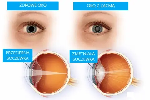 Porównanie zdrowego oka z przezierną soczewką i oka z zaćmą ze zmętniałą soczewką.