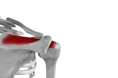 Schulteranatomie: Rot hervorgehobene Supraspinatussehne. Bei einem Riss der Supraspinatussehne was tun?