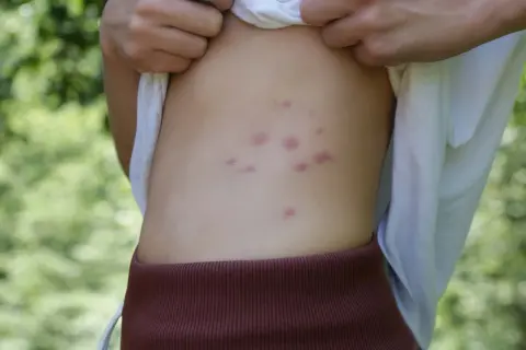 Picaduras de pulgas en humanos: síntomas, tratamiento y prevención eficaz