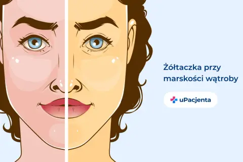 Twarz podzielona na dwie części: zdrową i zażółconą, ilustrująca żółtaczkę przy marskości wątroby.