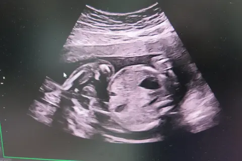Ultraljud vecka 19 visar ett sovande barn. Ansiktet är tydligt, med en liten näsa och mun. Barnet har armarna uppdragna mot huvudet.