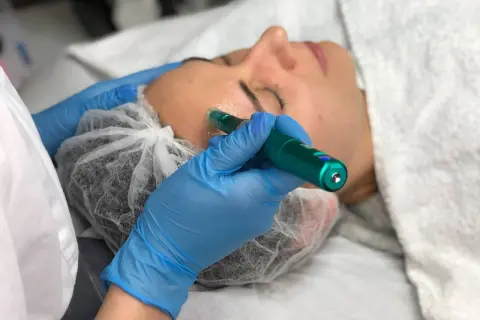 Zabieg dermapen. Kosmetolog w niebieskich rękawiczkach wykonuje mikronakłuwanie skóry twarzy. Pamiętaj o zaleceniach po zabiegu.