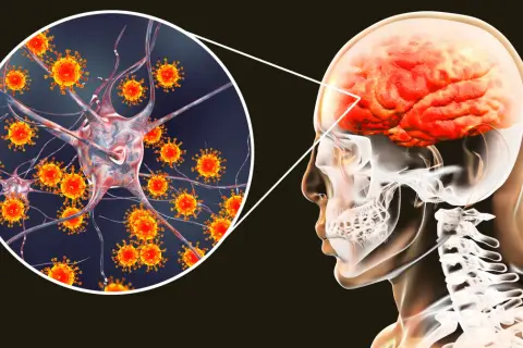 Ilustracja przedstawia wirusy atakujące neuron, co może prowadzić do kleszczowego zapalenia mózgu. Widoczny jest również przekrój głowy z mózgiem.