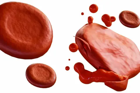 Czerwone krwinki, jedna z nich pęka, uwalniając zawartość. To obraz hemolizy, rozpadu komórek krwi.