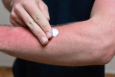 Mann trägt Salbe auf stark geröteten Arm auf, der unter brennender Haut leidet.